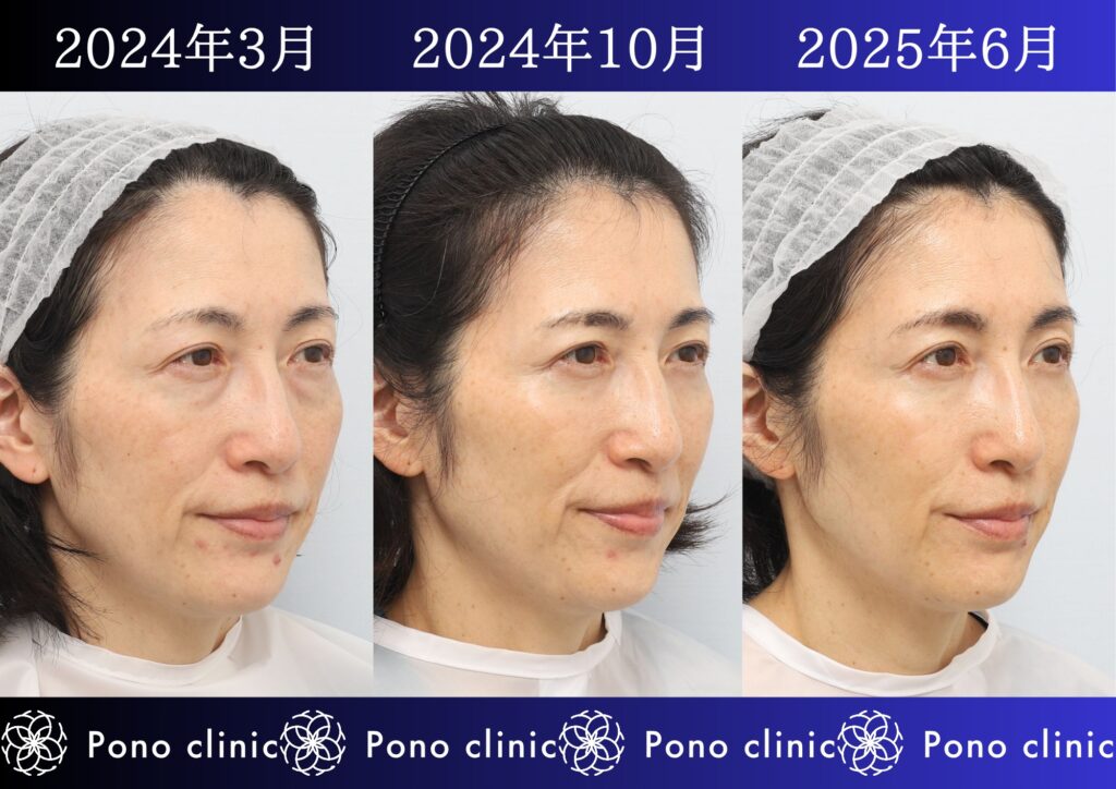 50代女性の症例、アンチエイジング治療、目の下のクマ取り、しわ治療、裏ハムラ法、PRP (1)