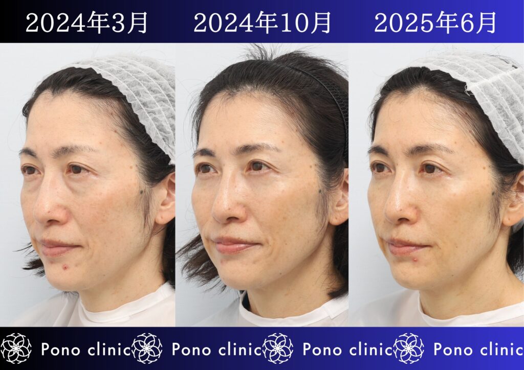 50代女性の症例、アンチエイジング治療、目の下のクマ取り、しわ治療、裏ハムラ法、PRP (2)