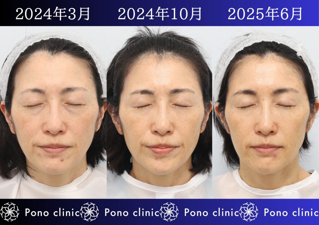 50代女性の症例、アンチエイジング治療、目の下のクマ取り、しわ治療、裏ハムラ法、PRP (3)