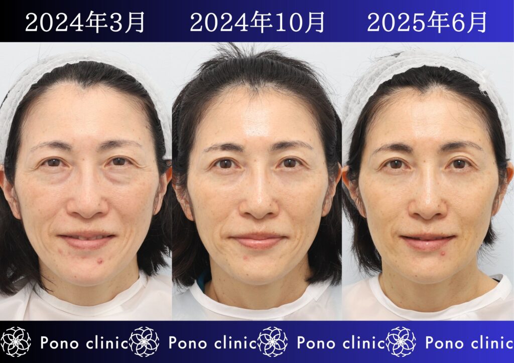 50代女性の症例、アンチエイジング治療、目の下のクマ取り、しわ治療、裏ハムラ法、PRP (4)