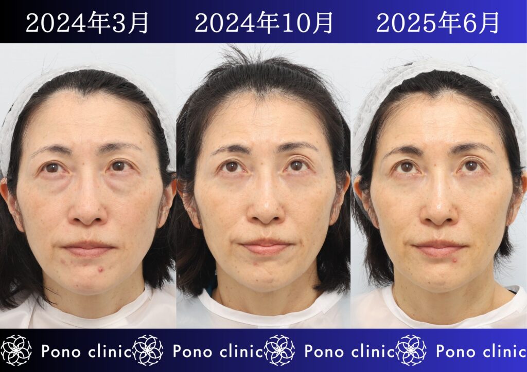 50代女性の症例、アンチエイジング治療、目の下のクマ取り、しわ治療、裏ハムラ法、PRP (5)