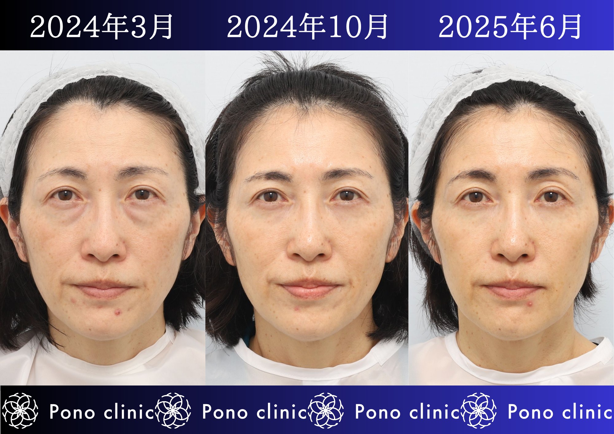 50代女性の症例、アンチエイジング治療、目の下のクマ取り、しわ治療、裏ハムラ法、PRP (6)