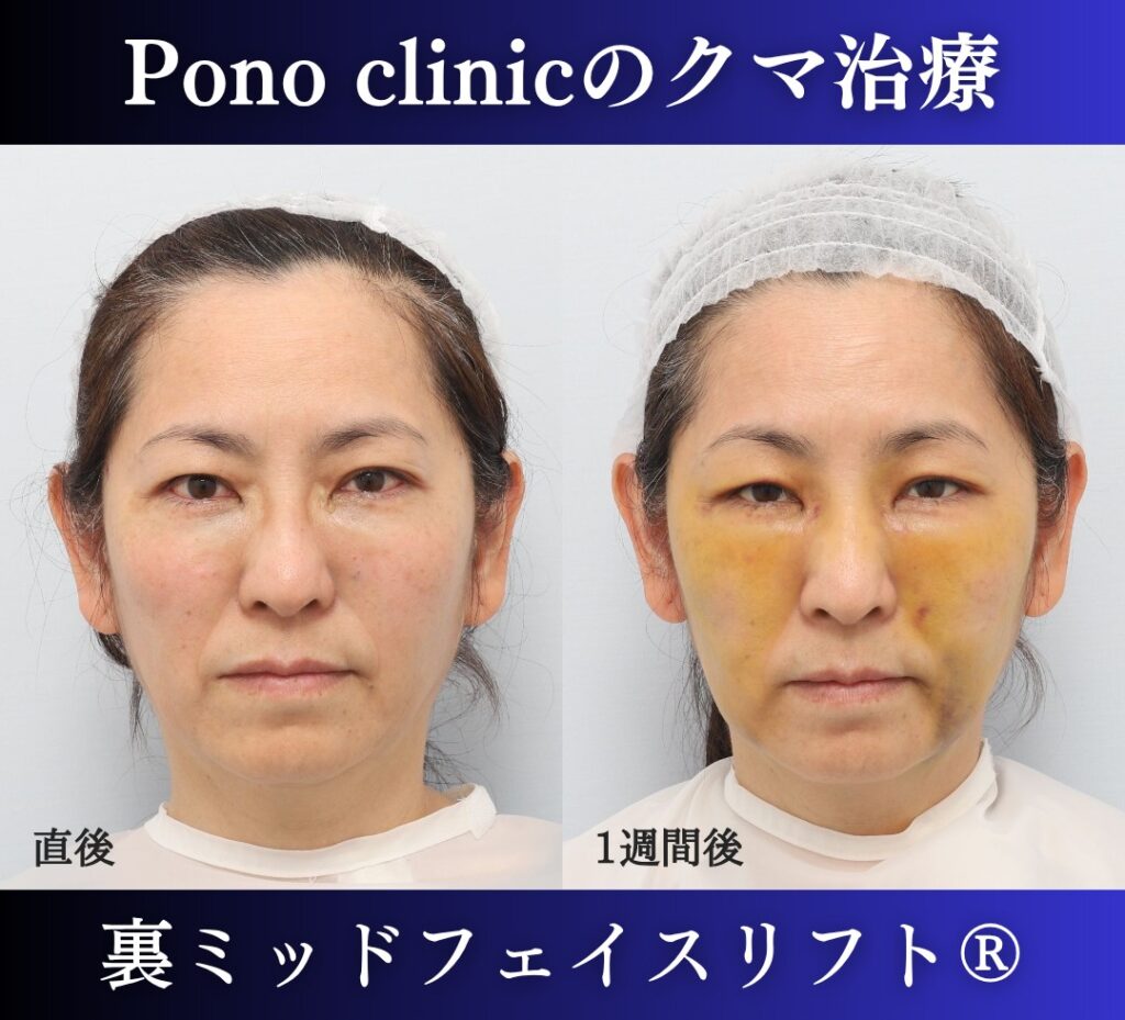 50代女性の症例、目の下のクマ取り、裏ハムラ法、ミッドフェイスリフト (1)