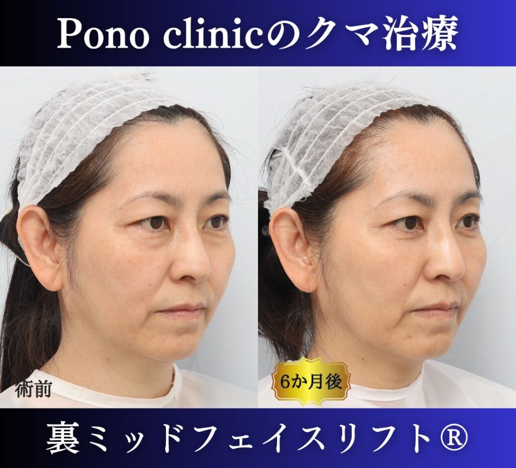 50代女性の症例、目の下のクマ取り、裏ハムラ法、ミッドフェイスリフト (2)