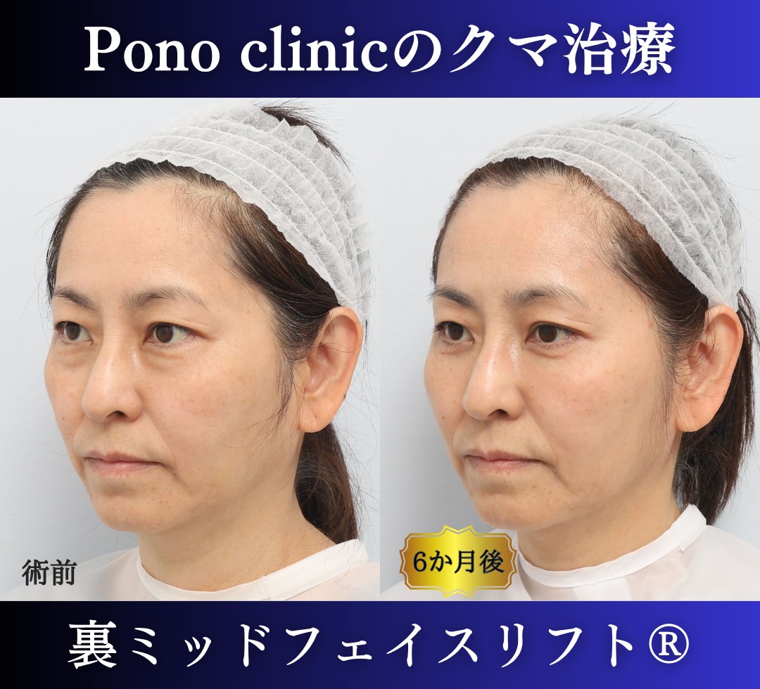 50代女性の症例、目の下のクマ取り、裏ハムラ法、ミッドフェイスリフト (3)