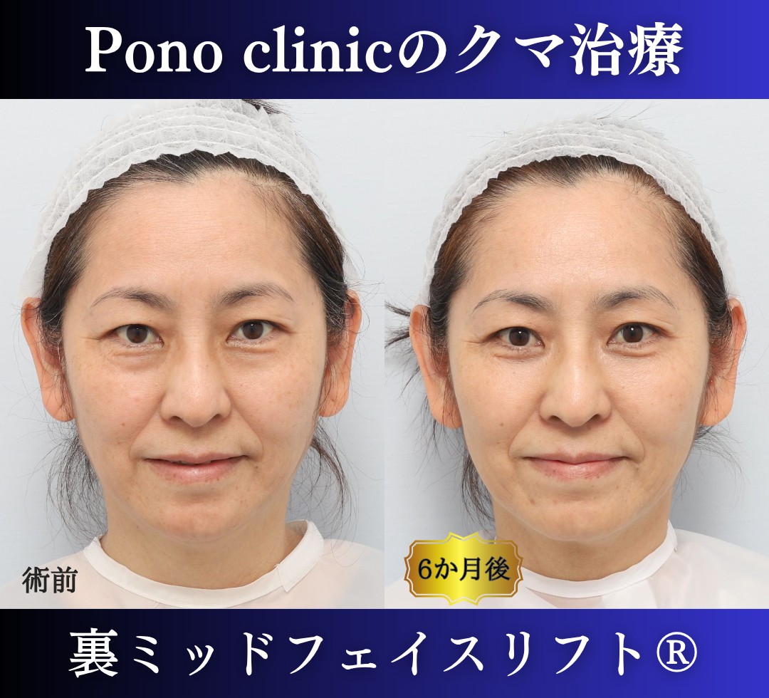 50代女性の症例、目の下のクマ取り、裏ハムラ法、ミッドフェイスリフト (4)