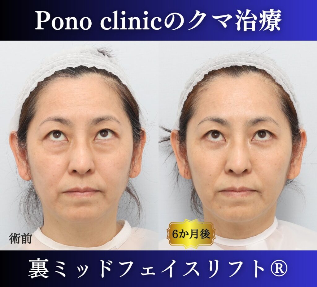 50代女性の症例、目の下のクマ取り、裏ハムラ法、ミッドフェイスリフト (5)