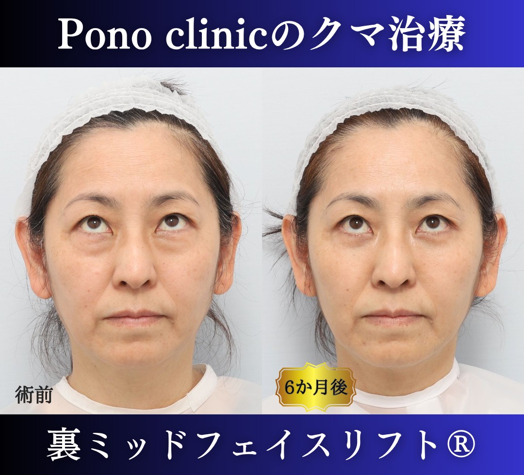 50代女性の症例、目の下のクマ取り、裏ハムラ法、ミッドフェイスリフト (5)