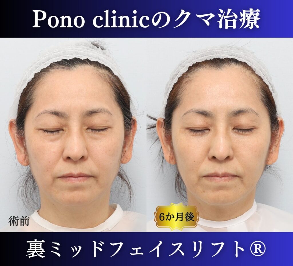 50代女性の症例、目の下のクマ取り、裏ハムラ法、ミッドフェイスリフト (6)
