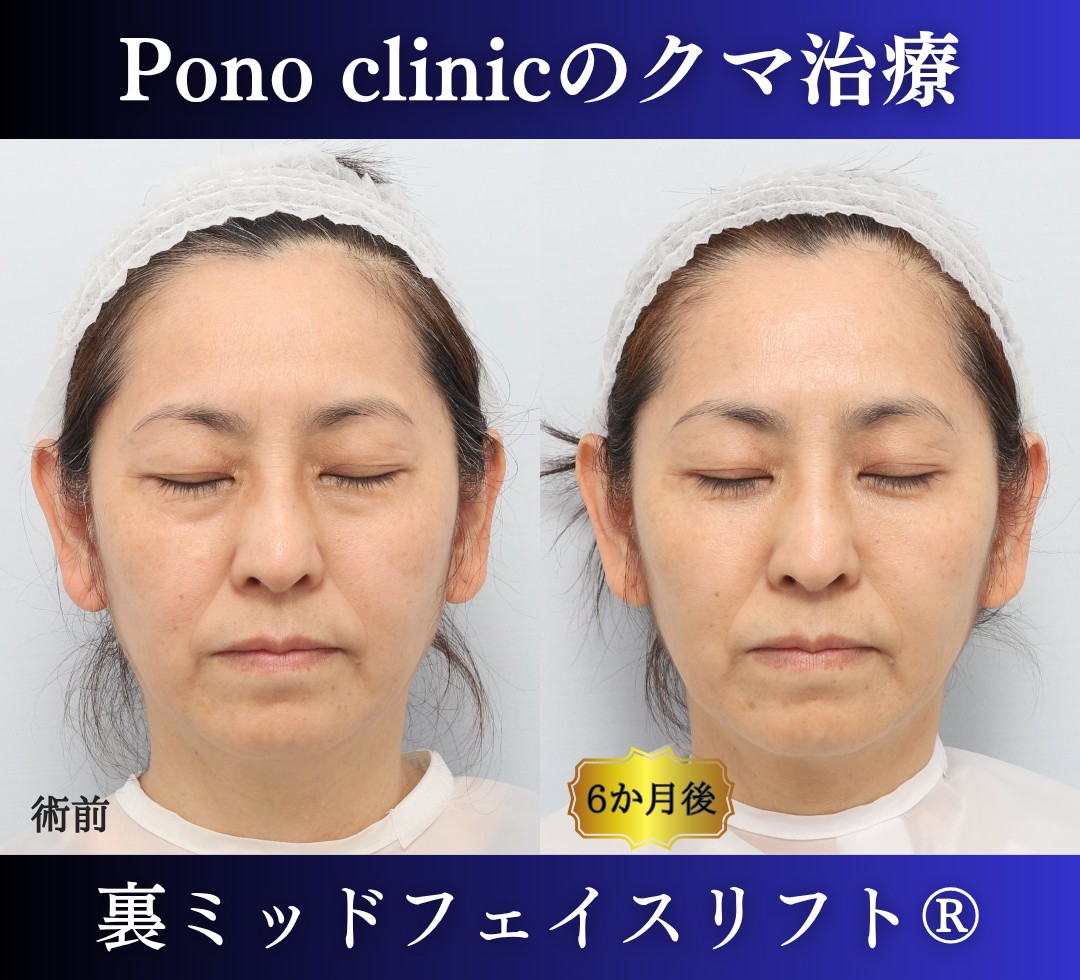 50代女性の症例、目の下のクマ取り、裏ハムラ法、ミッドフェイスリフト (6)