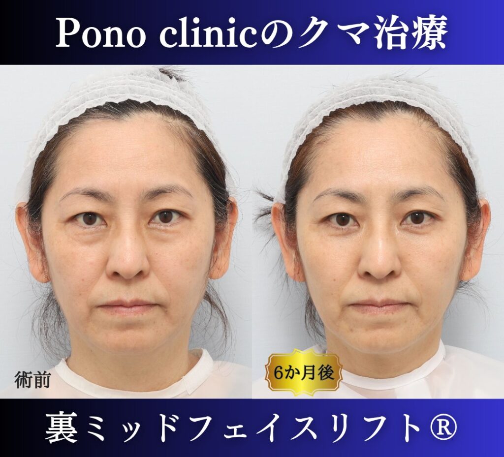 50代女性の症例、目の下のクマ取り、裏ハムラ法、ミッドフェイスリフト (7)