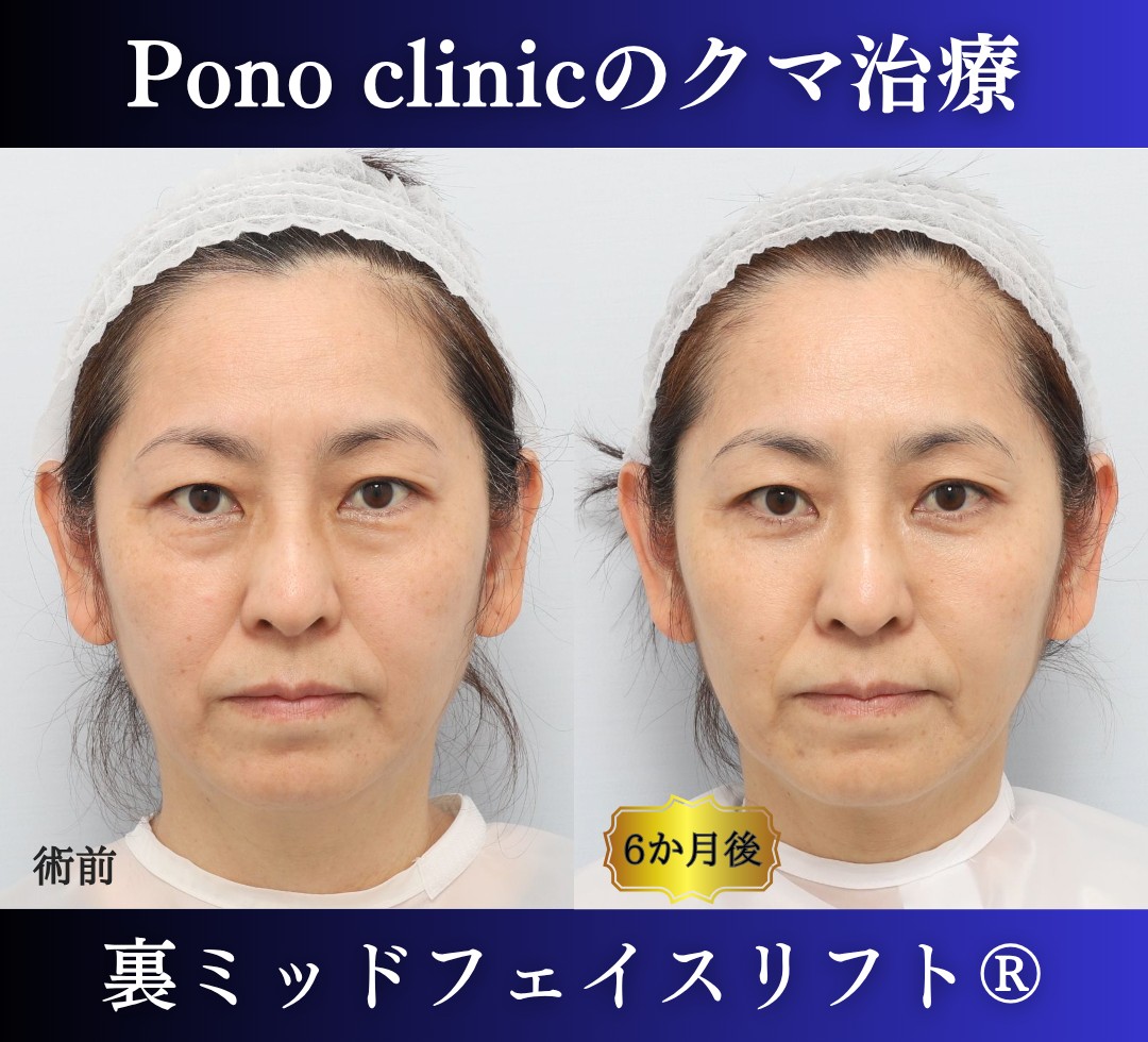 50代女性の症例、目の下のクマ取り、裏ハムラ法、ミッドフェイスリフト (7)