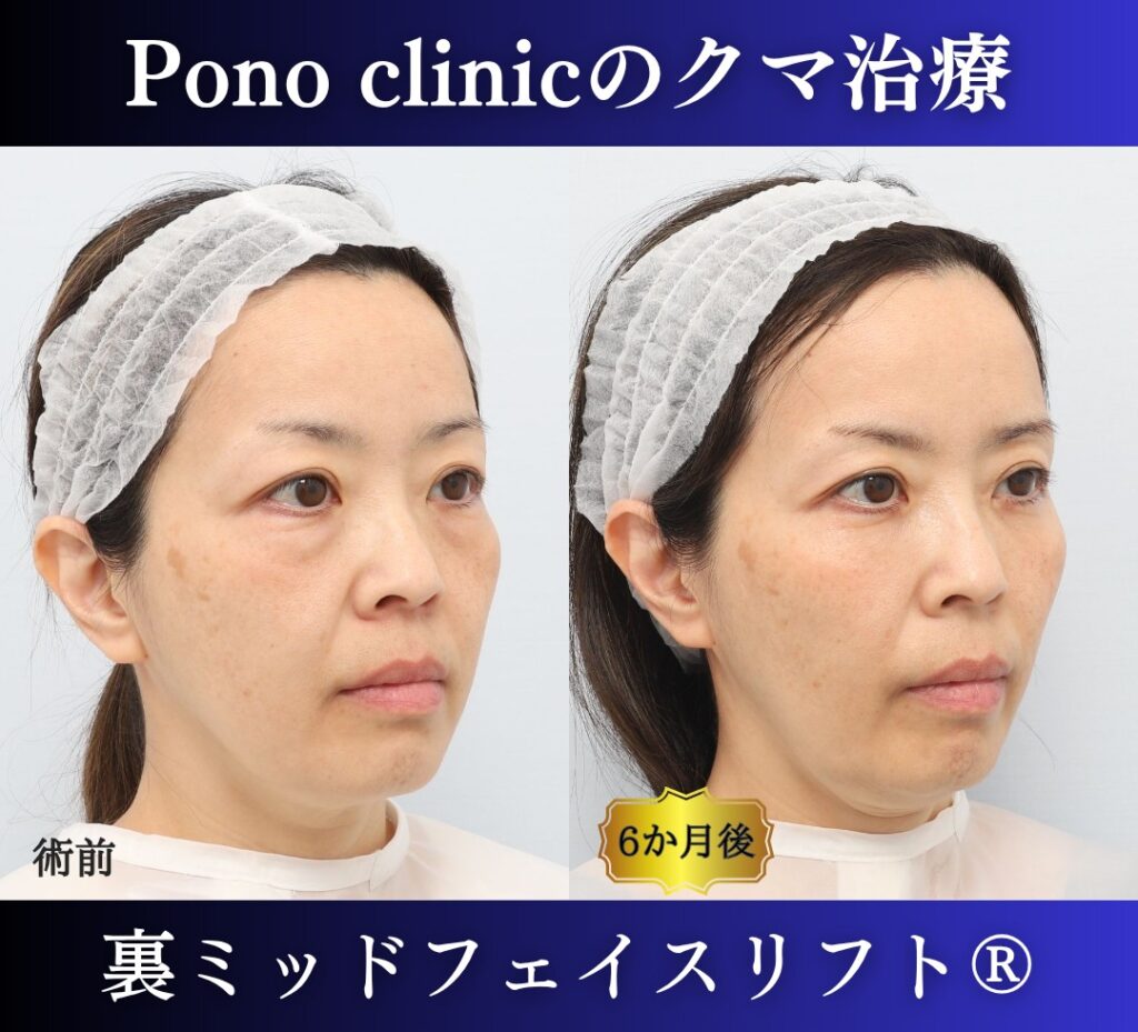 50代女性の症例、目の下のクマ取り、裏ミッドフェイスリフト、裏ハムラ (2)