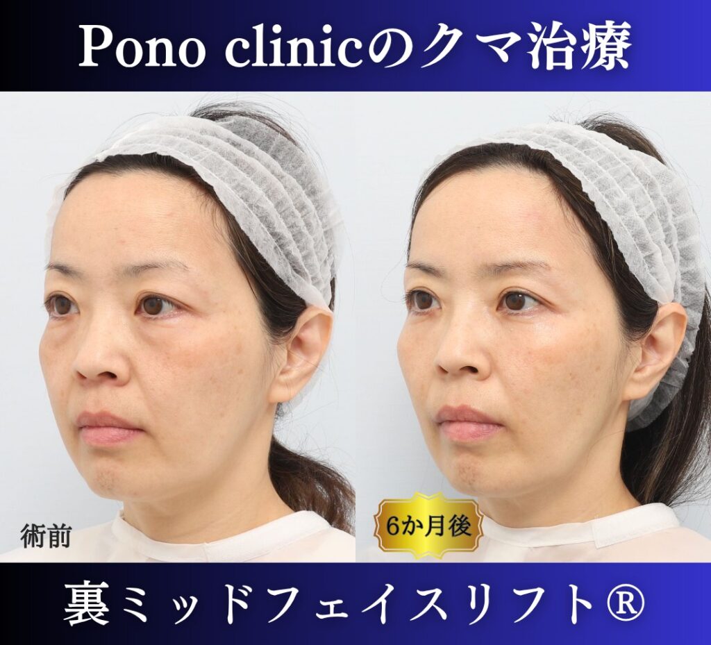 50代女性の症例、目の下のクマ取り、裏ミッドフェイスリフト、裏ハムラ (3)