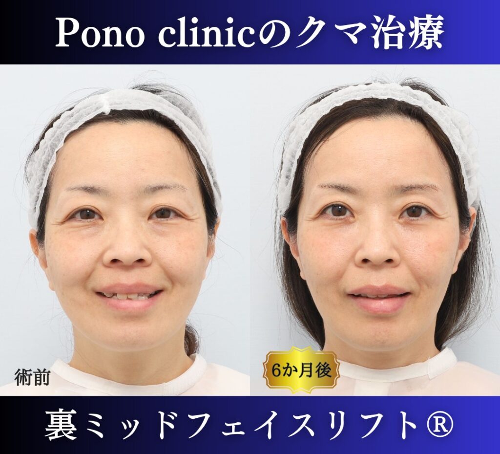 50代女性の症例、目の下のクマ取り、裏ミッドフェイスリフト、裏ハムラ (4)