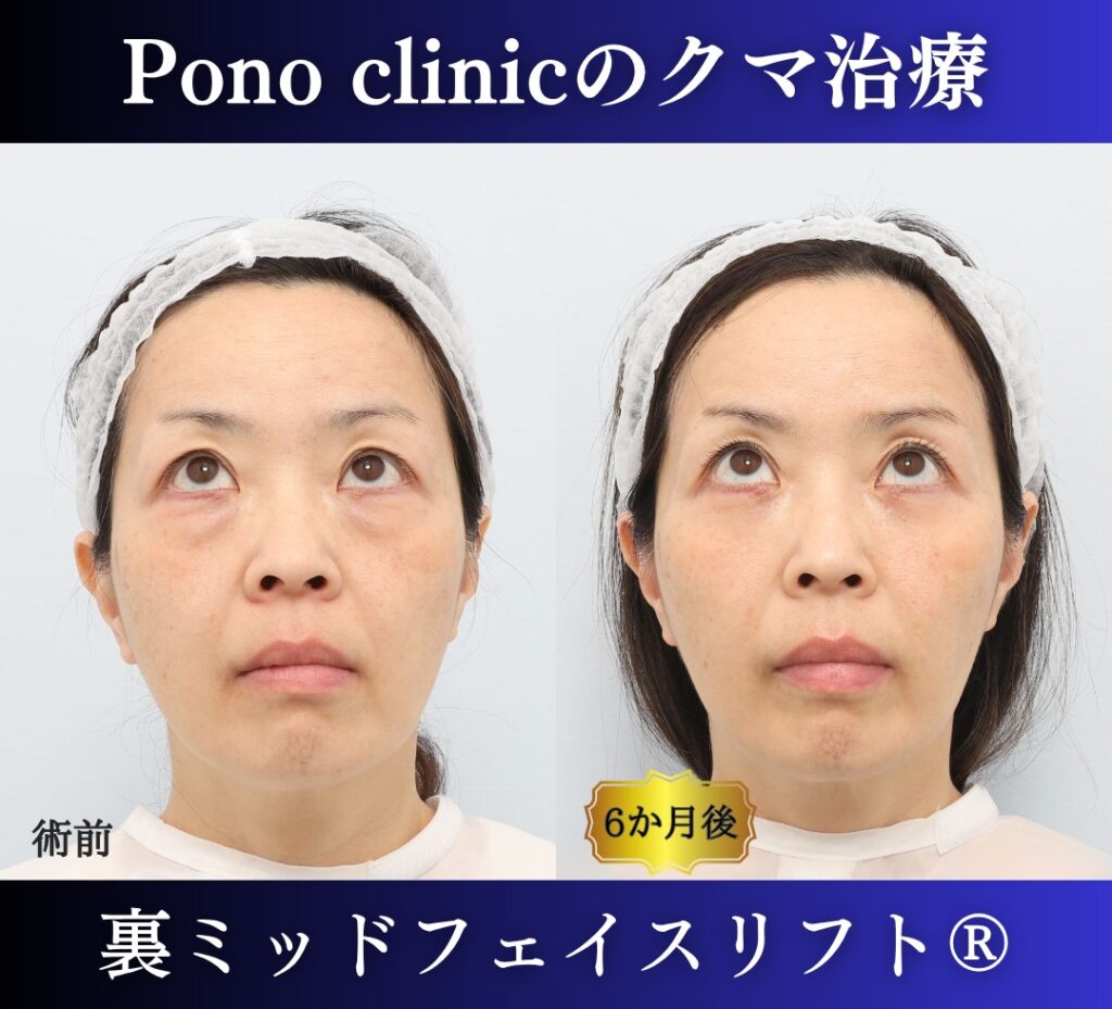 50代女性の症例、目の下のクマ取り、裏ミッドフェイスリフト、裏ハムラ (5