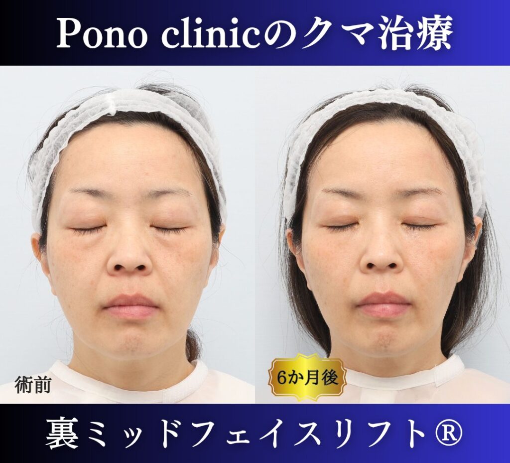 50代女性の症例、目の下のクマ取り、裏ミッドフェイスリフト、裏ハムラ (6)