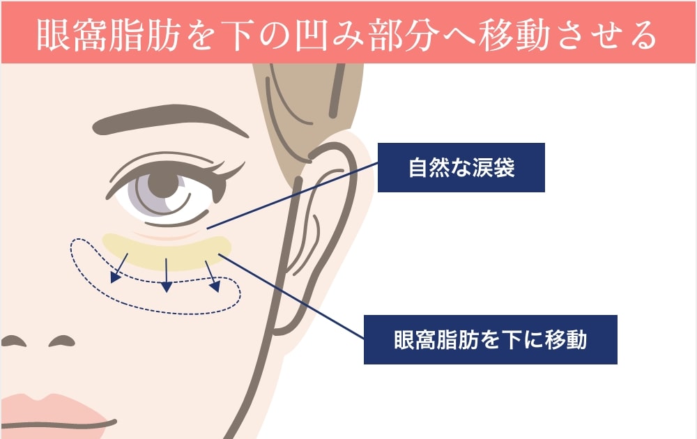 脂肪を凹み部分へ移動するイラスト