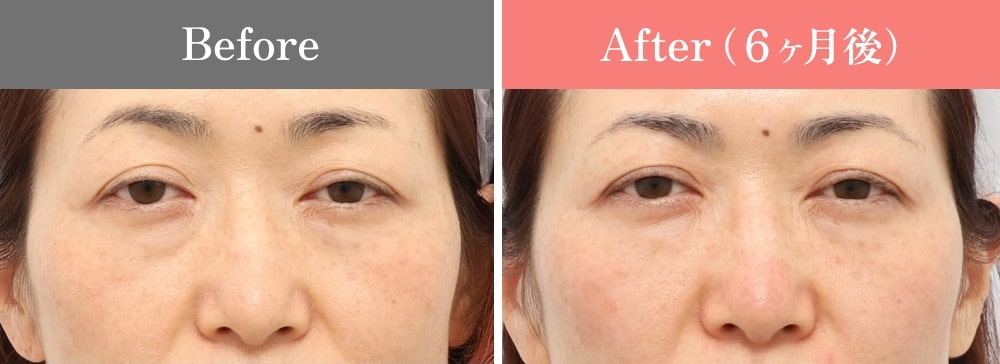 CASE01.PRPF®療法(目の下、ゴルゴライン)の症例