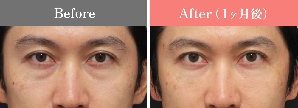 CASE02.PRPF®療法(目の下・法令線)の症例