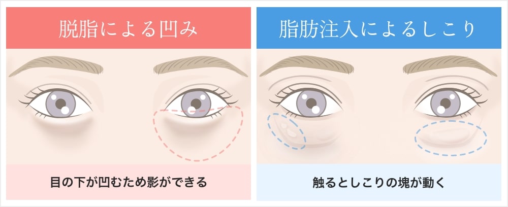 脱脂によるへこみと脂肪注入によるしこりの説明