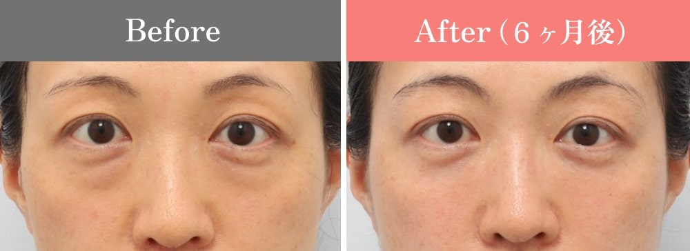 裏ミッドフェイスリフト®の症例06