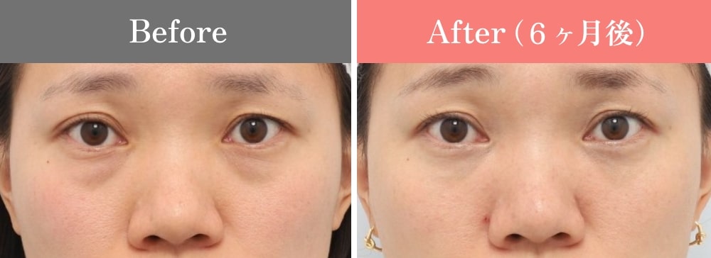 裏ミッドフェイスリフト®の症例04