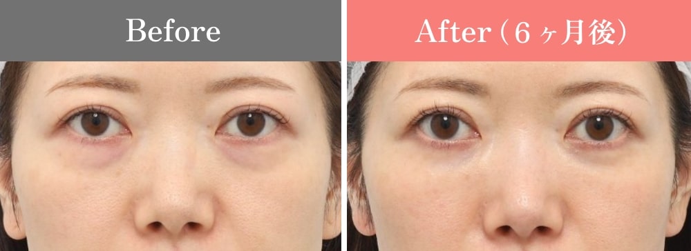 裏ミッドフェイスリフト®の症例01