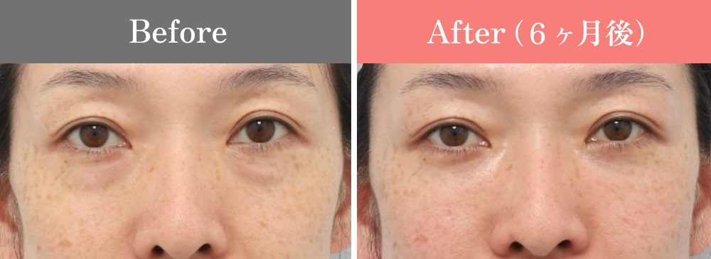 裏ミッドフェイスリフト®の症例02