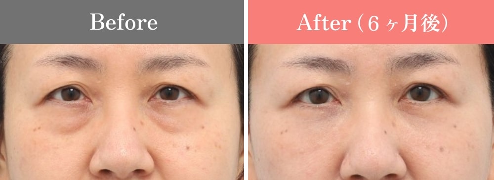 裏ミッドフェイスリフト®の症例05