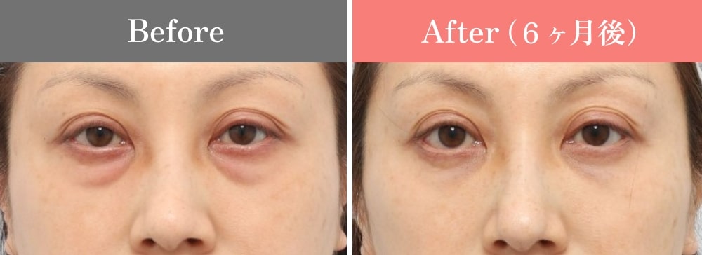 裏ミッドフェイスリフト®の症例03