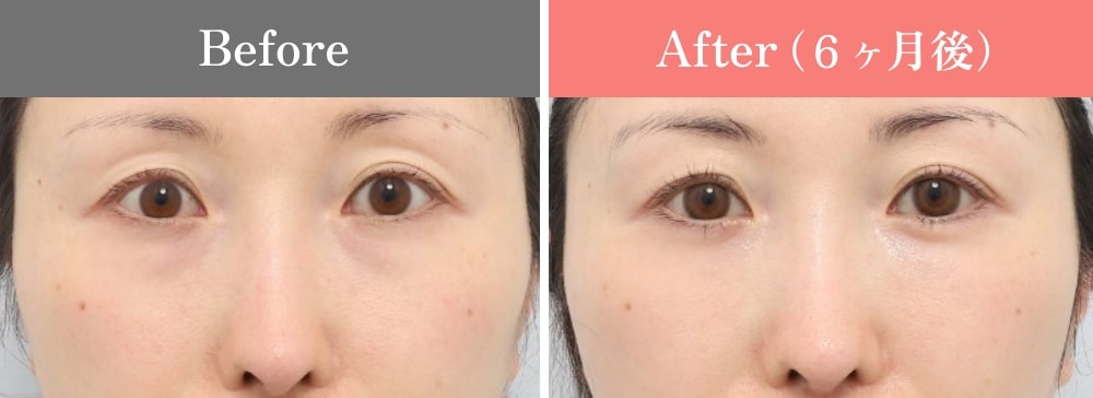 裏ミッドフェイスリフト®の症例07