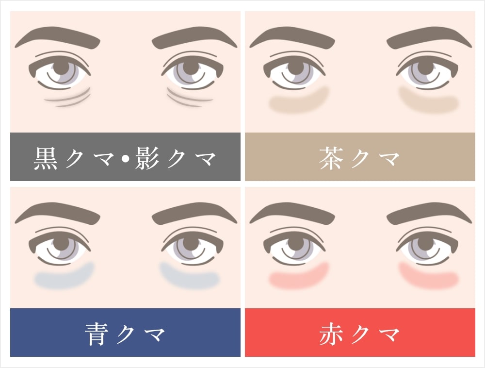 目の下のたるみとクマの違い