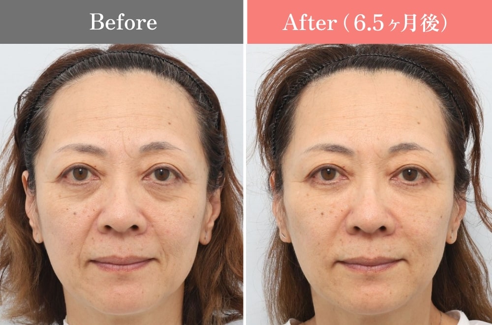 PRPF®療法の症例01