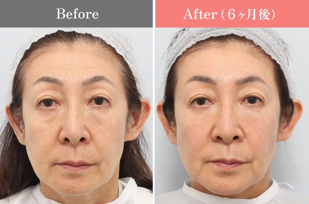 PRPF®療法の症例02