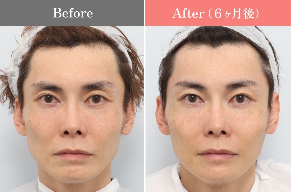 PRPF®療法の症例03