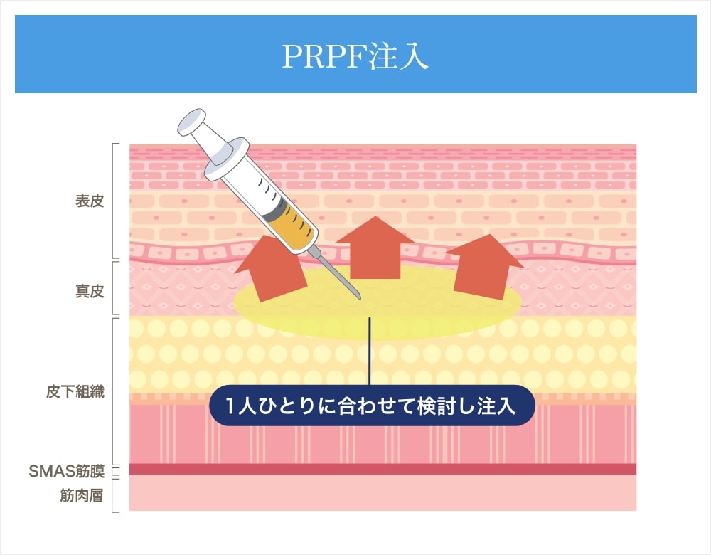 PRPF注入の解説