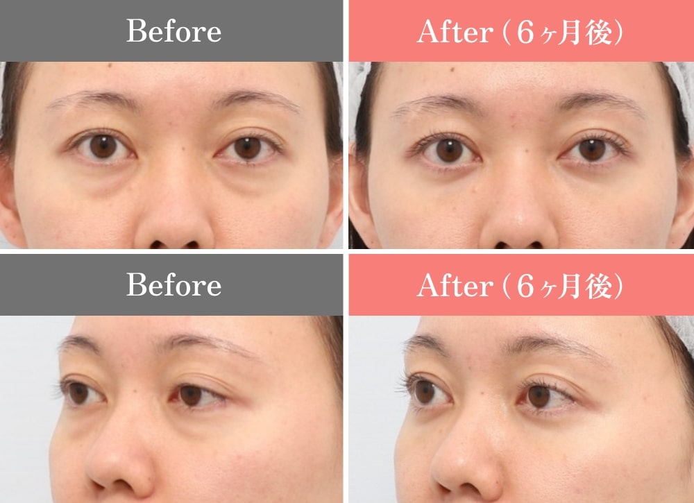 CASE02.裏ミッドフェイスリフト®の症例