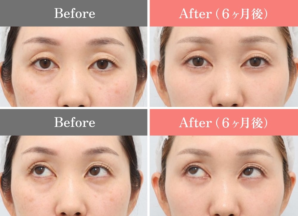 CASE03.裏ミッドフェイスリフト®の症例