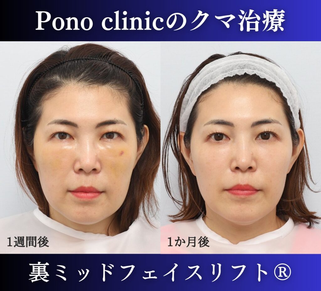 40代の症例、目の下のクマ取り、裏ハムラ法、ミッドフェイスリフト (1)