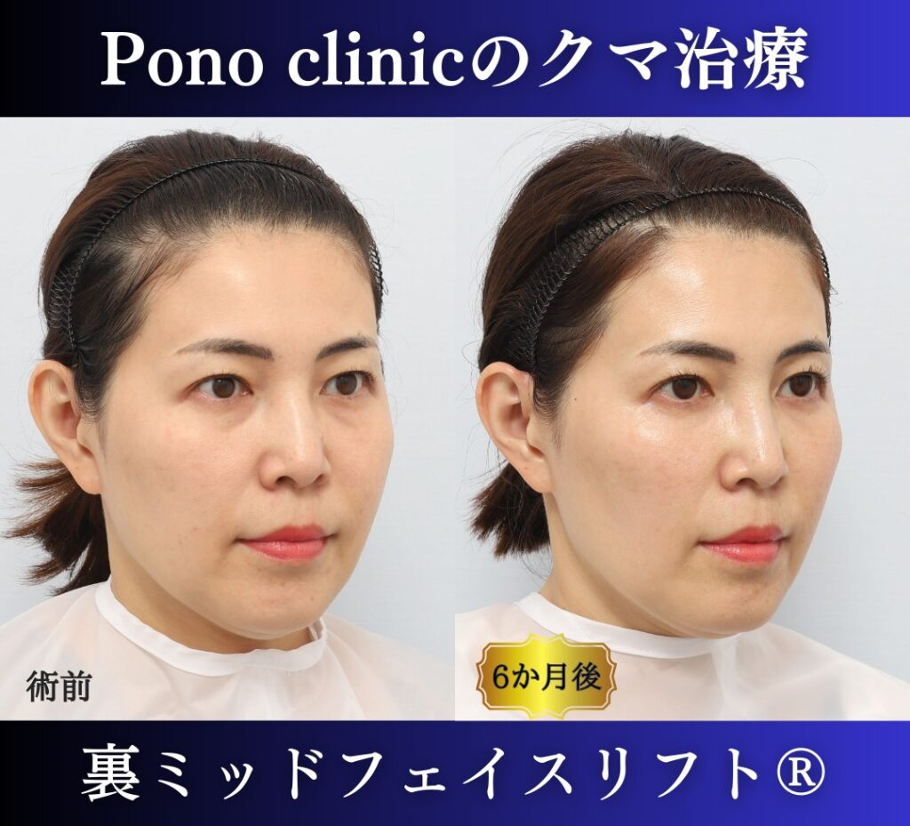 40代の症例、目の下のクマ取り、裏ハムラ法、ミッドフェイスリフト (2)