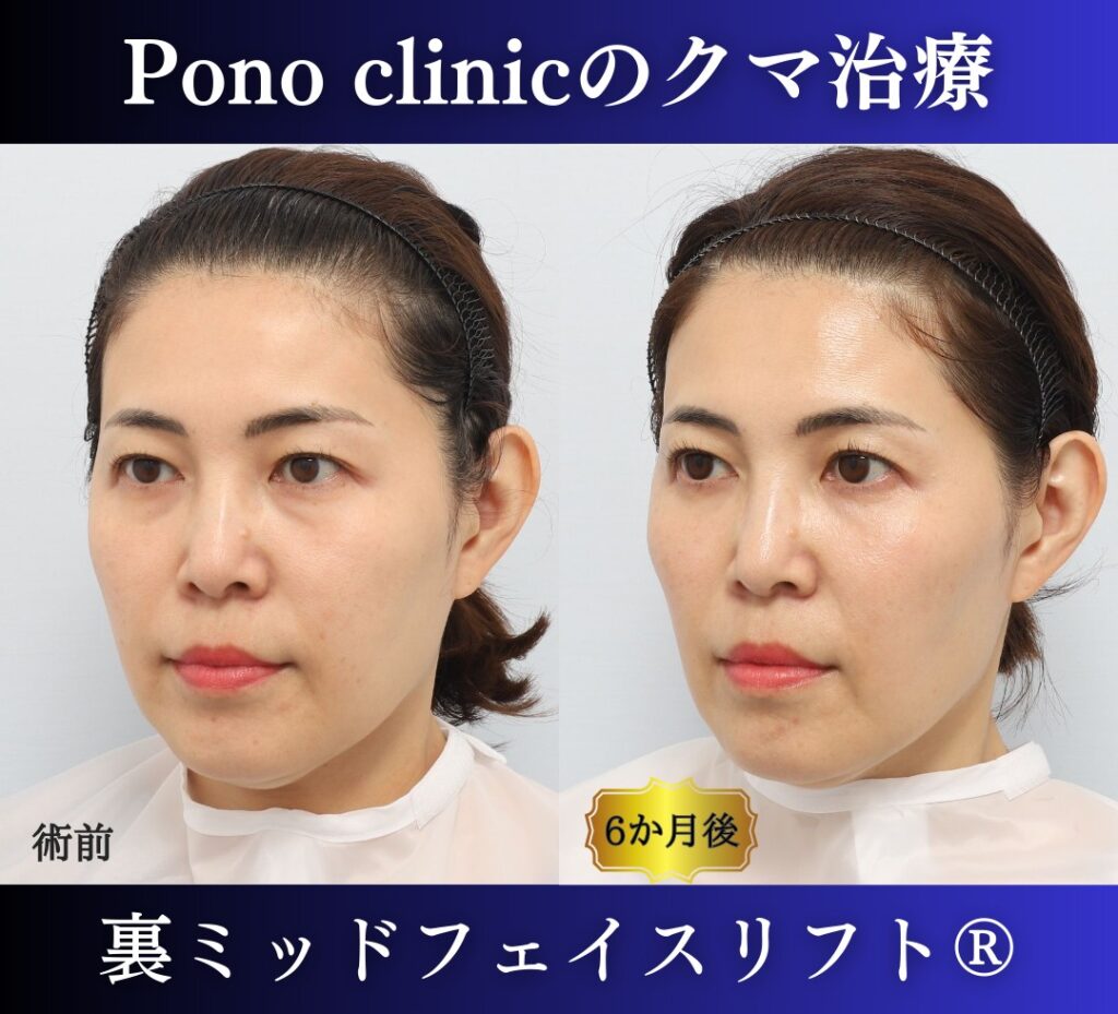 40代の症例、目の下のクマ取り、裏ハムラ法、ミッドフェイスリフト (3)