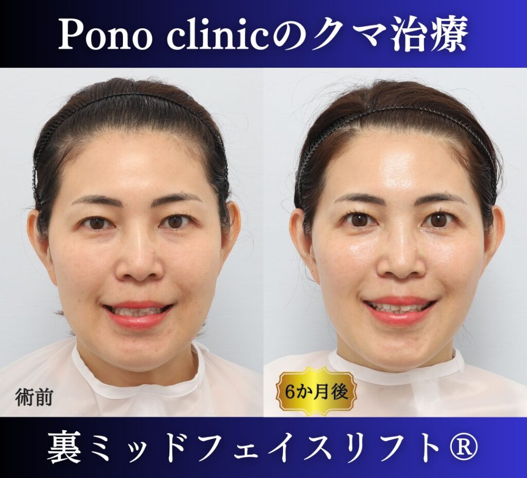 40代の症例、目の下のクマ取り、裏ハムラ法、ミッドフェイスリフト (4)