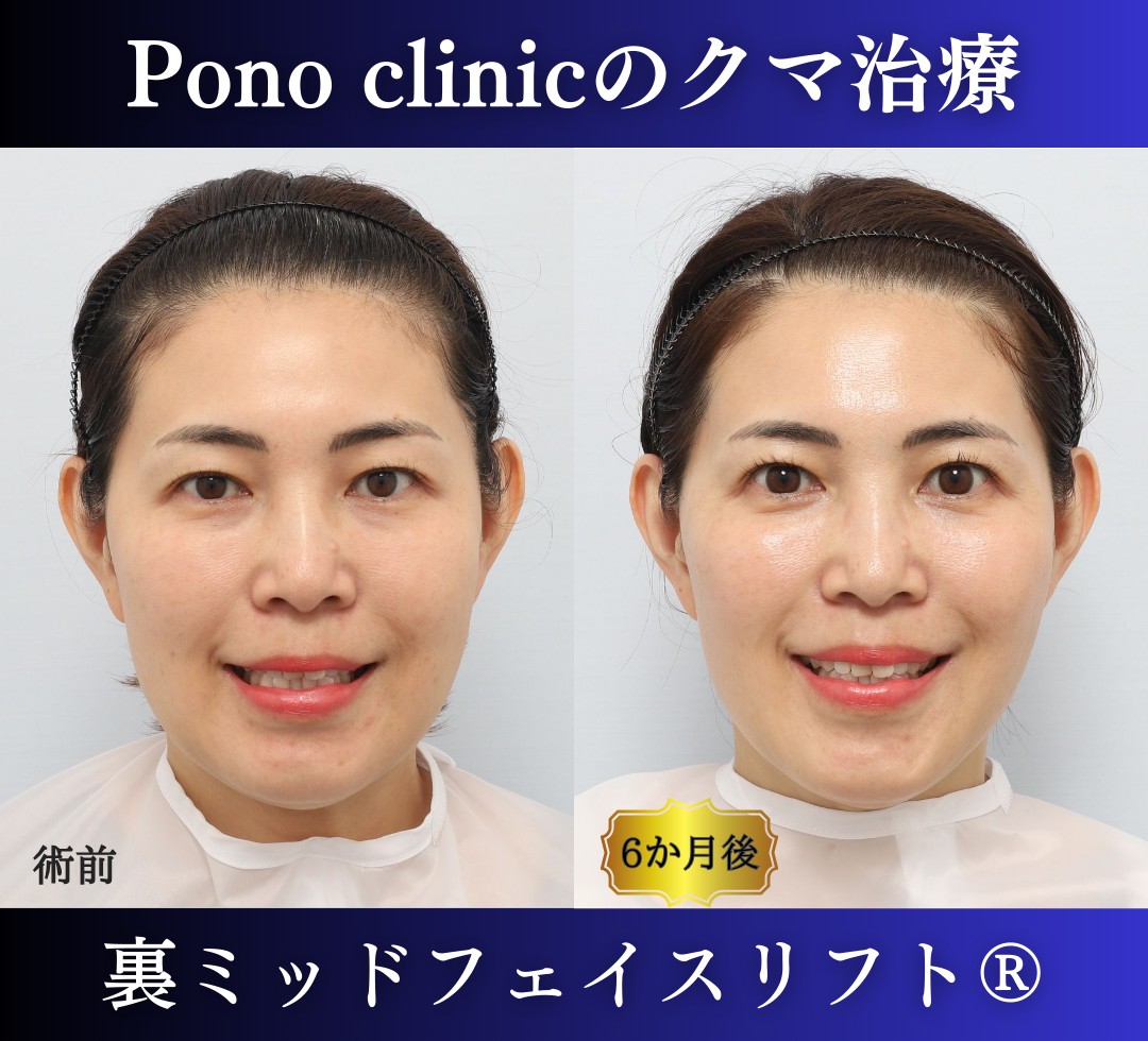 40代の症例、目の下のクマ取り、裏ハムラ法、ミッドフェイスリフト (4)