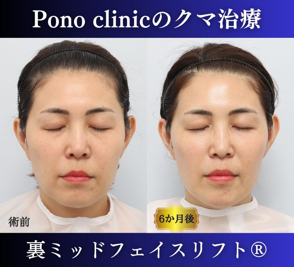 40代の症例、目の下のクマ取り、裏ハムラ法、ミッドフェイスリフト (6)