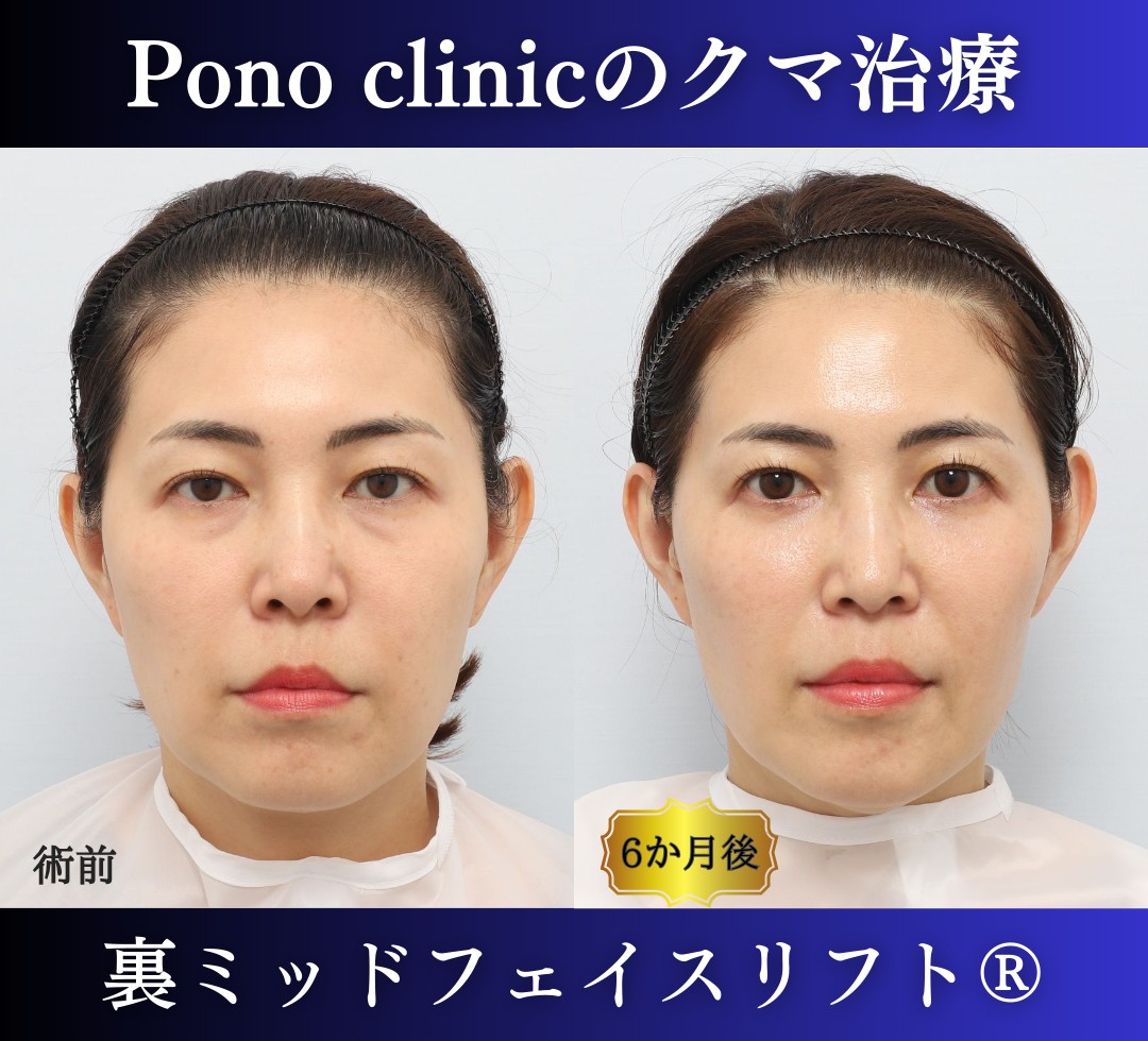 40代の症例、目の下のクマ取り、裏ハムラ法、ミッドフェイスリフト (7)