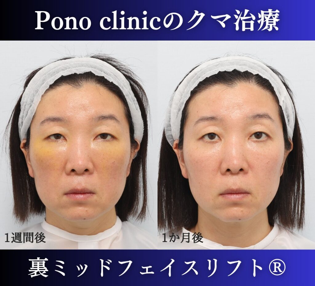 40代女性、目の下のクマ取り、裏ミッドフェイスリフト、裏ハムラ (1)