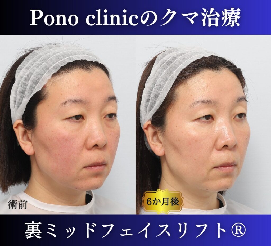 40代女性、目の下のクマ取り、裏ミッドフェイスリフト、裏ハムラ (2)