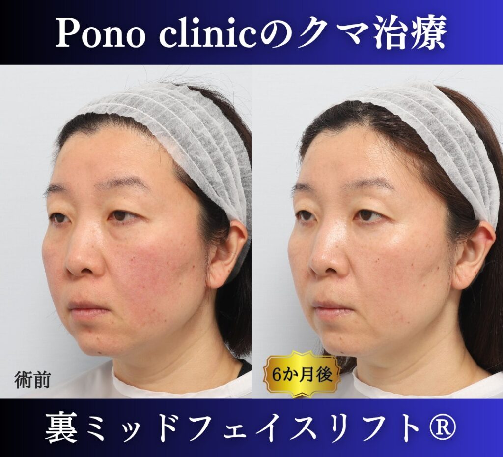 40代女性、目の下のクマ取り、裏ミッドフェイスリフト、裏ハムラ (3)