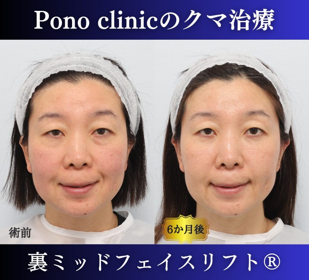 40代女性、目の下のクマ取り、裏ミッドフェイスリフト、裏ハムラ (4)